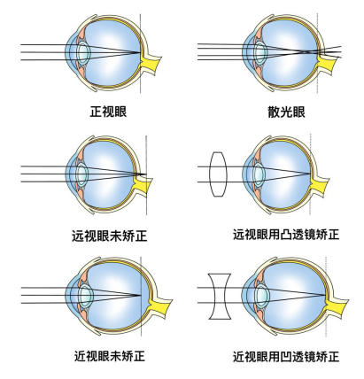 光和屈光參差.